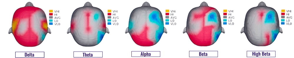 Irvine Neurofeedback Training Brain Mapping Image of Delta, Theta, Alpha, Beta, and High Beat Brain Readings